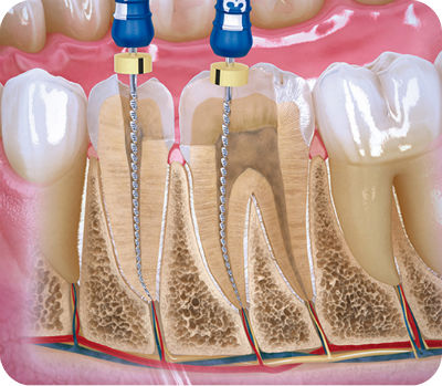 Ilustración de un tratamiento de endodoncia con limas en los conductos radiculares