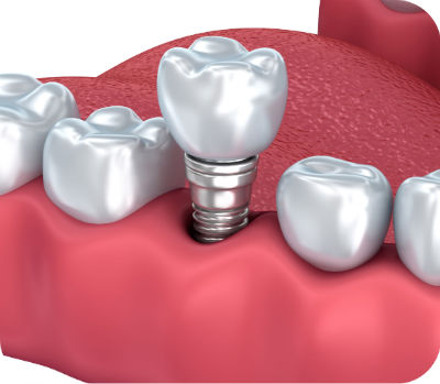Implantes dentales