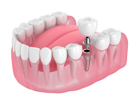 Ilustración de un implante dental: tornillo, pilar y corona