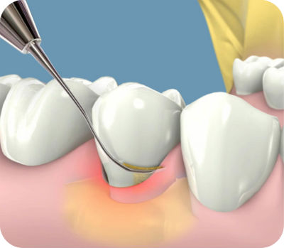 Periodoncia